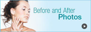Laser skin resurfacing before and after photos