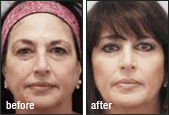 Skin Resurfacing Before and After Photos